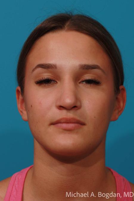 After image 1 Case #108356 - Rhinoplasty