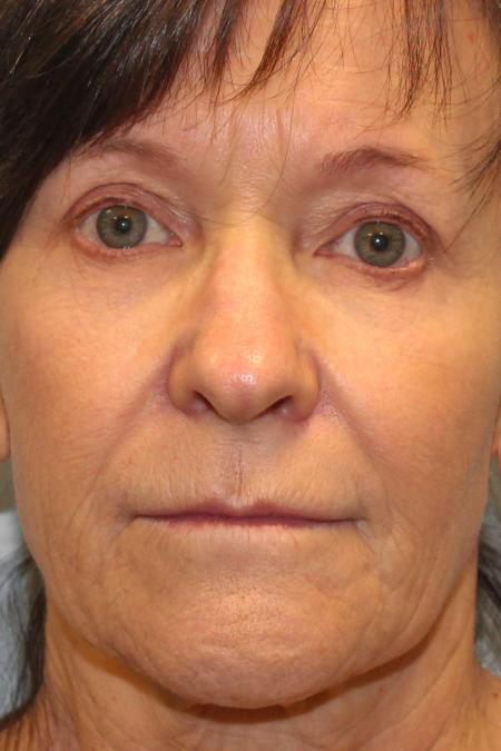 Before image 1 Case #108286 - Facelift & Blepharoplasty