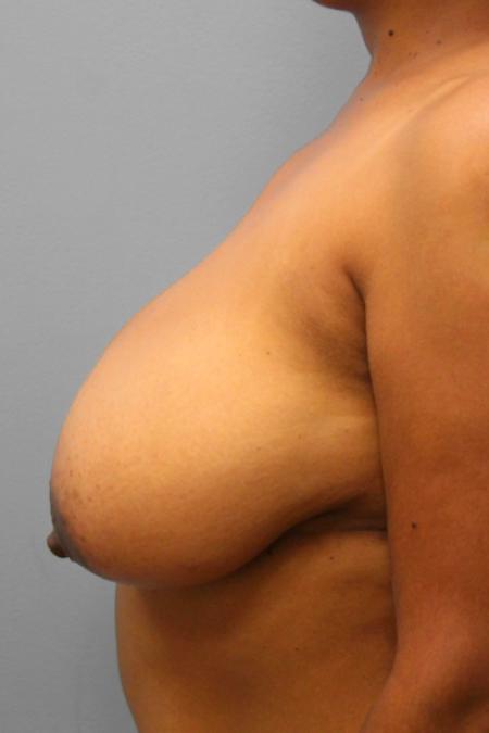 Before image 3 Case #108266 - Breast Reduction