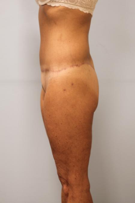 After image 3 Case #107591 - Body Lift