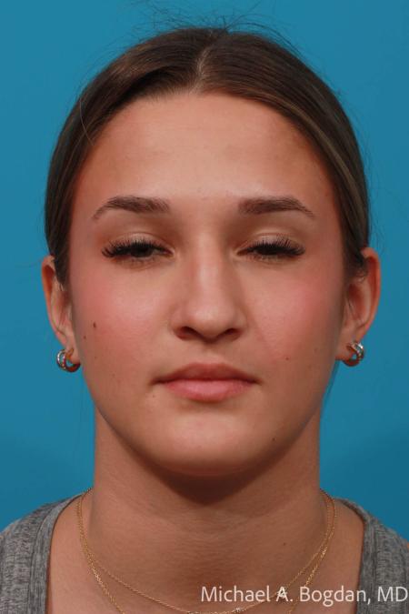Before image 1 Case #108356 - Rhinoplasty