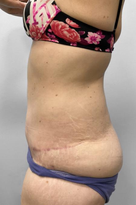 After image 3 Case #108161 - Tummy Tuck & Arm Lift