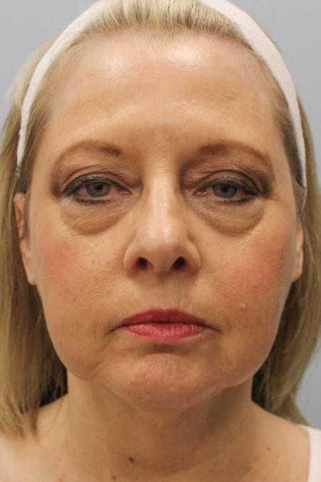 Before image 1 Case #108151 - Facelift & Blepharoplasty