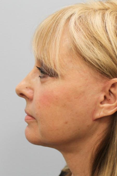 After image 3 Case #108151 - Facelift & Blepharoplasty