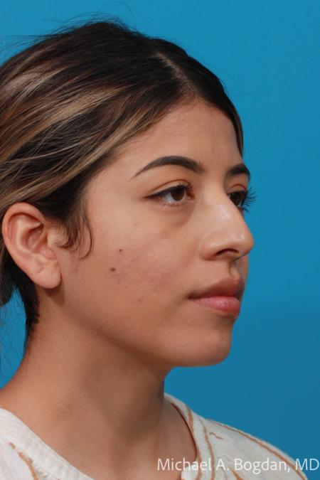 Before image 2 Case #108611 - Rhinoplasty