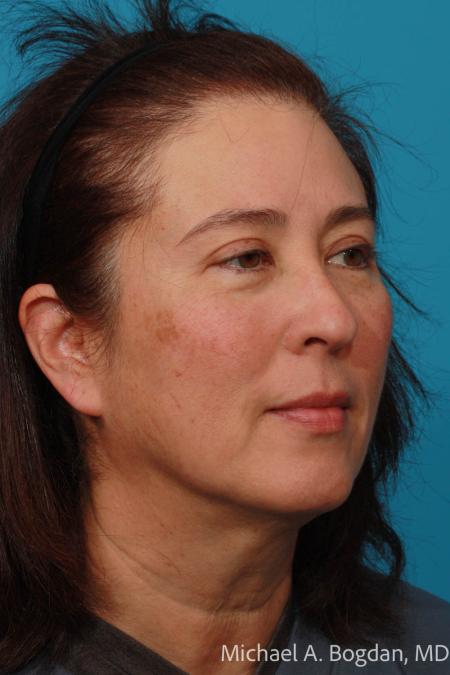 After image 2 Case #108616 - Blepharoplasty
