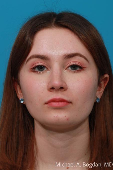After image 1 Case #108621 - Rhinoplasty
