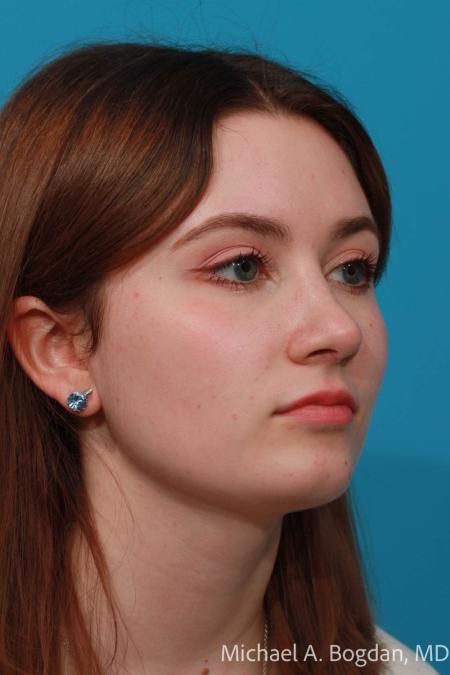 After image 2 Case #108621 - Rhinoplasty