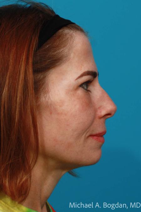 After image 3 Case #108646 - Blepharoplasty