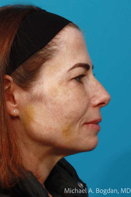 Before image 3 Case #108646 - Blepharoplasty