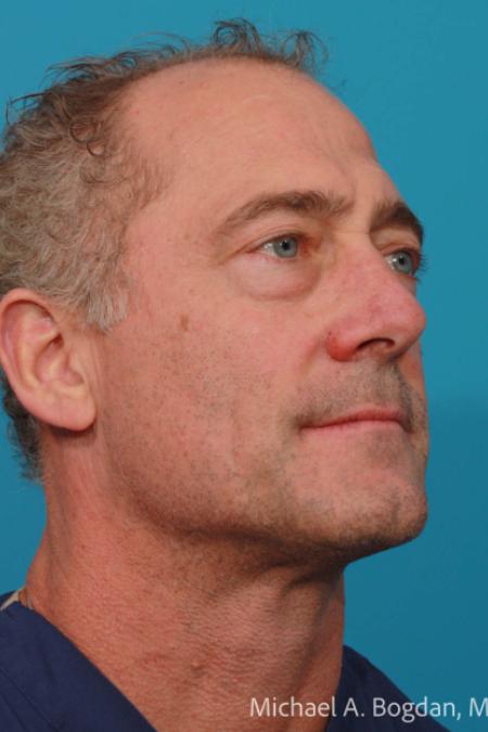 Before image 2 Case #108606 - Blepharoplasty