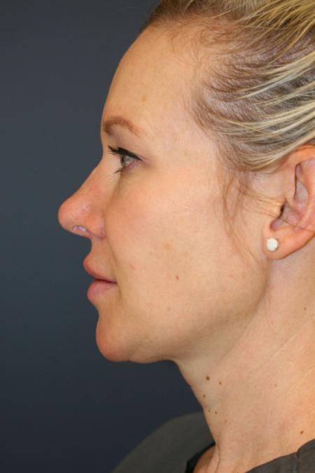 After image 3 Case #108841 - Rhinoplasty