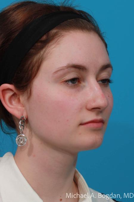 Before image 2 Case #108621 - Rhinoplasty