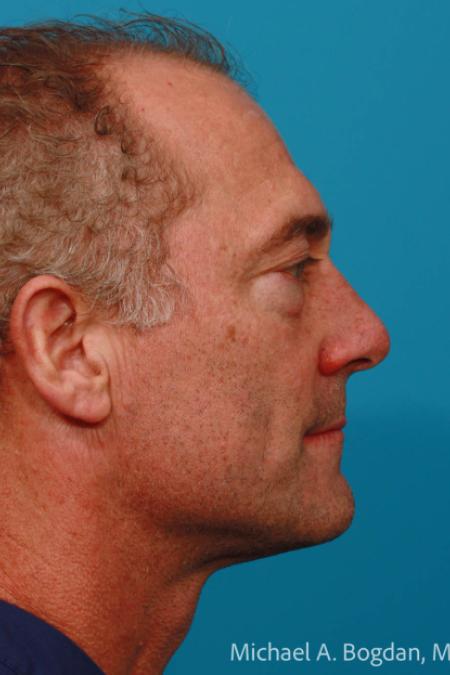 Before image 3 Case #108606 - Blepharoplasty