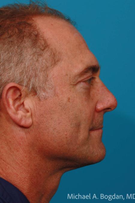 After image 3 Case #108606 - Blepharoplasty
