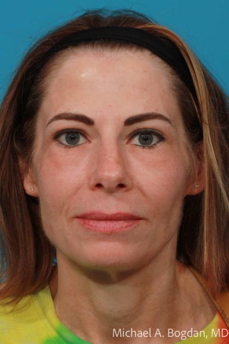 After image 1 Case #108646 - Blepharoplasty
