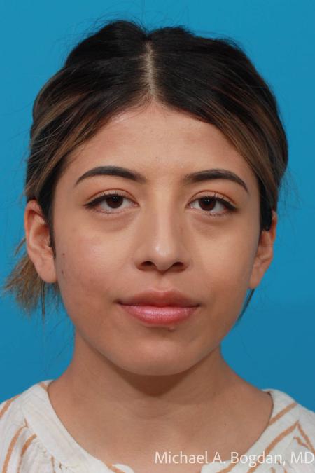 Before image 1 Case #108611 - Rhinoplasty