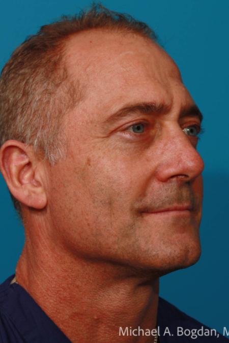 After image 2 Case #108606 - Blepharoplasty