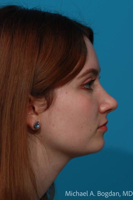 After image 3 Case #108621 - Rhinoplasty