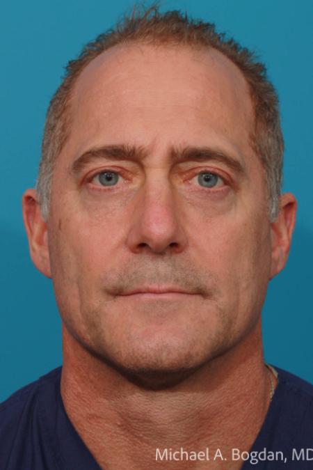 After image 1 Case #108606 - Blepharoplasty