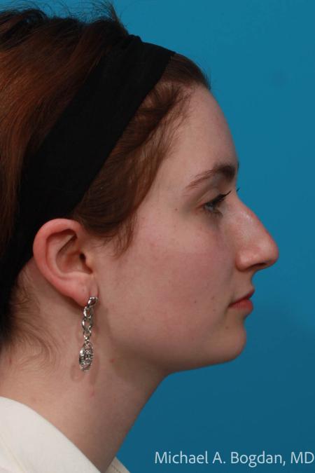 Before image 3 Case #108621 - Rhinoplasty