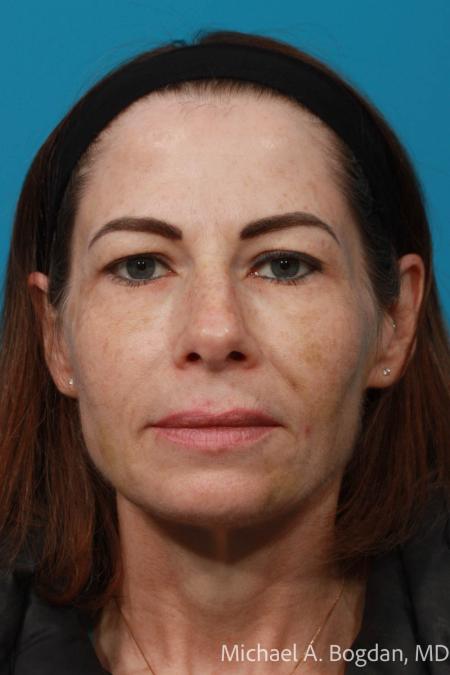 Before image 1 Case #108646 - Blepharoplasty