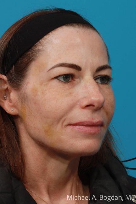 Before image 2 Case #108646 - Blepharoplasty