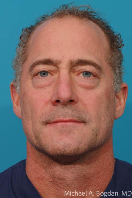 Before image 1 Case #108606 - Blepharoplasty