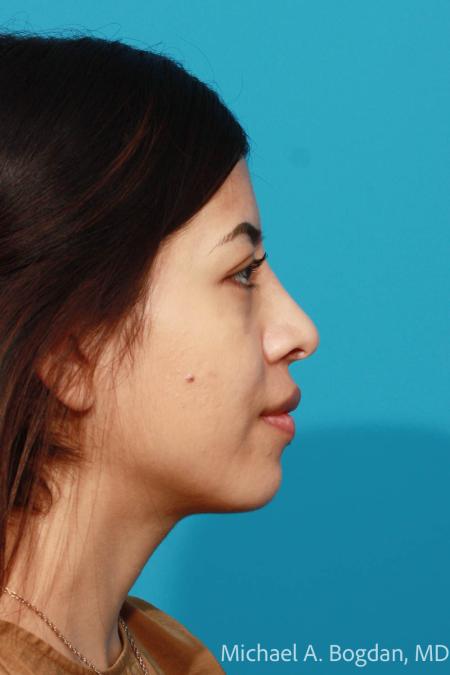 After image 3 Case #108611 - Rhinoplasty
