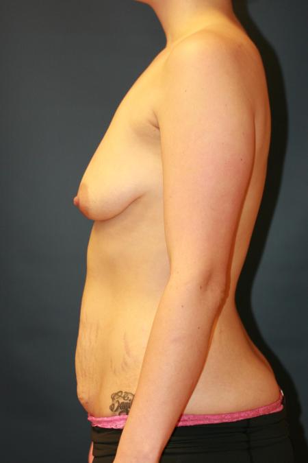Before image 3 Case #108406 - Mommy Makeover