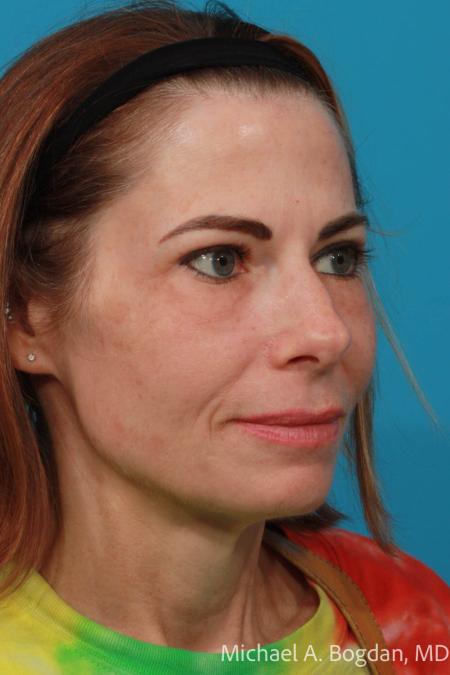 After image 2 Case #108646 - Blepharoplasty