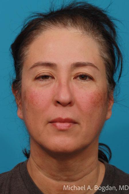 Before image 1 Case #108616 - Blepharoplasty