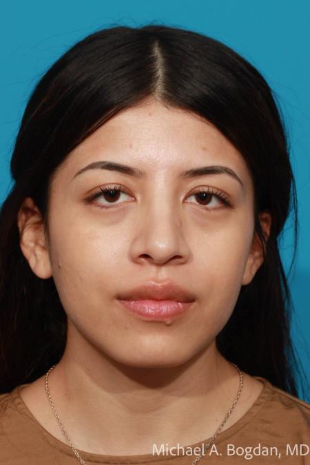 After image 1 Case #108611 - Rhinoplasty