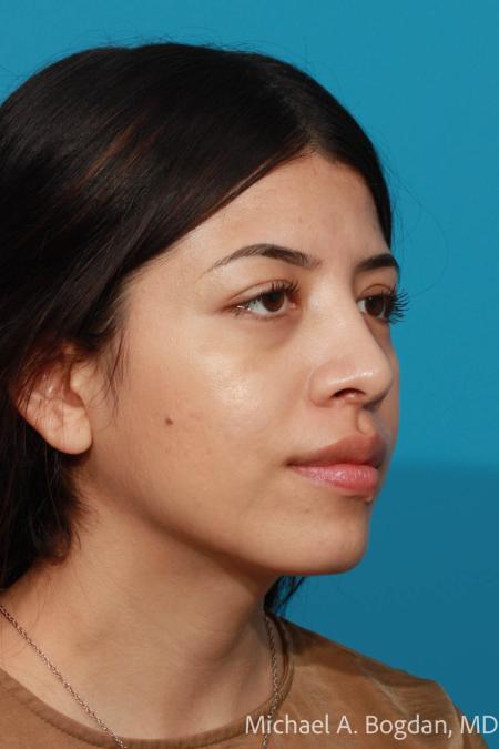 After image 2 Case #108611 - Rhinoplasty