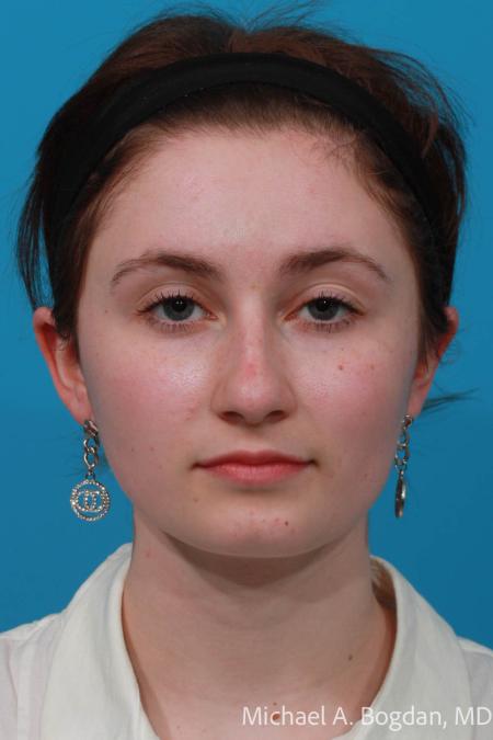Before image 1 Case #108621 - Rhinoplasty