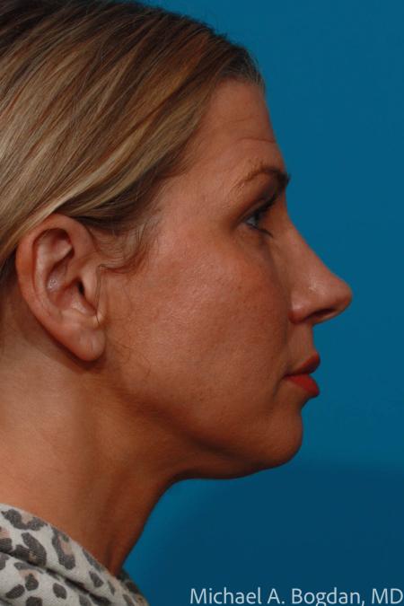 After image 3 Case #109016 - Rhinoplasty