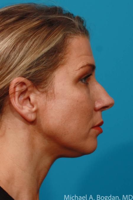 Before image 3 Case #109016 - Rhinoplasty