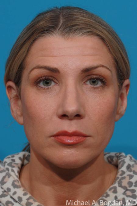 After image 1 Case #109016 - Rhinoplasty