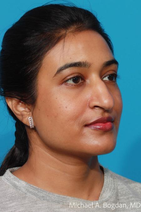 Before image 2 Case #109026 - Rhinoplasty