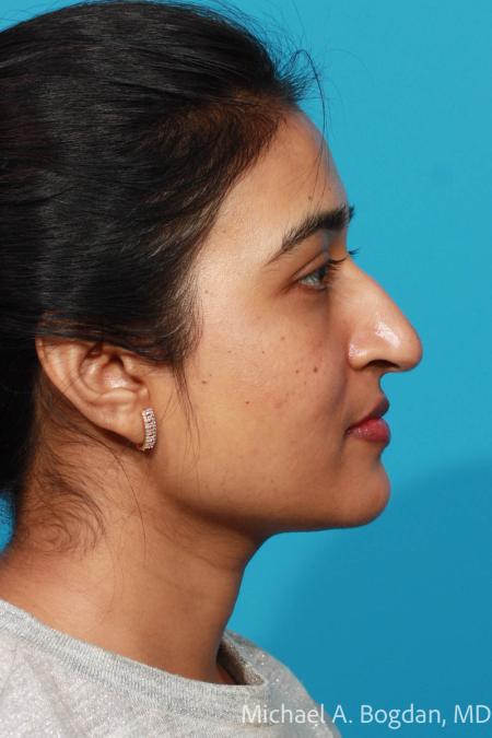 Before image 3 Case #109026 - Rhinoplasty