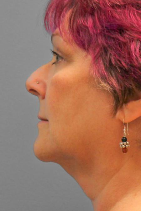 Before image 3 Case #109191 - Facelift & Upper Bleph