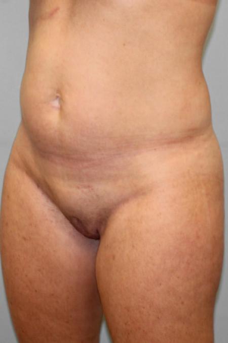 Before image 1 Case #109171 - Smart Lipo