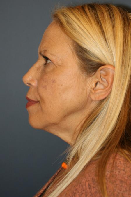 Before image 3 Case #109266 - Facelift/Necklift