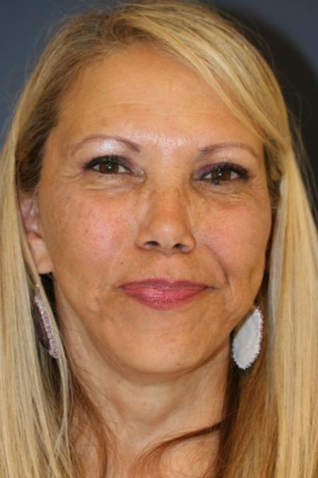 After image 1 Case #109266 - Facelift/Necklift
