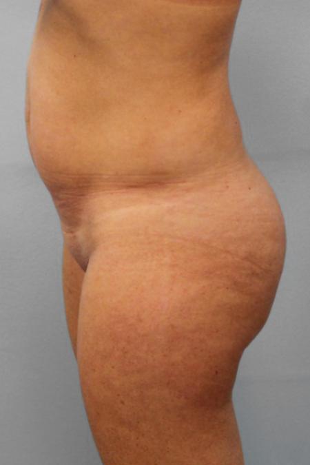 Before image 2 Case #109171 - Smart Lipo