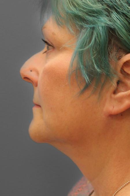 After image 3 Case #109191 - Facelift & Upper Bleph