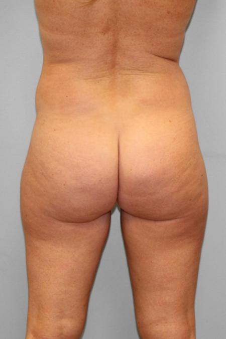 Before image 3 Case #109171 - Smart Lipo