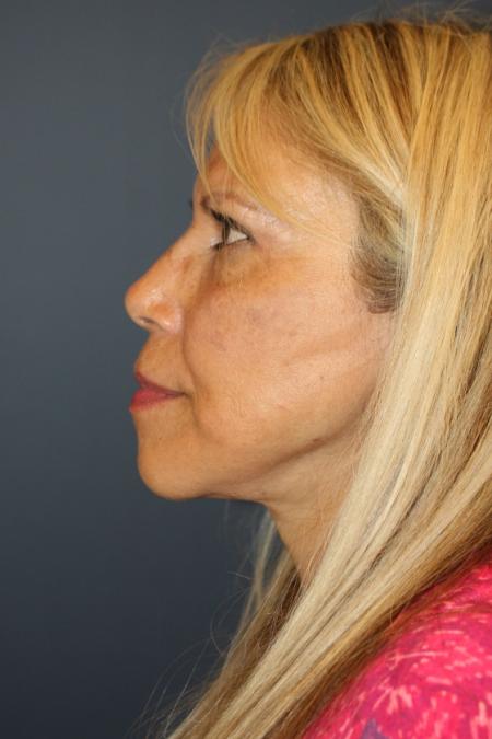 After image 3 Case #109266 - Facelift/Necklift