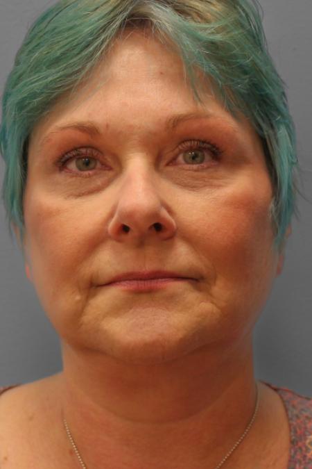 After image 1 Case #109191 - Facelift & Upper Bleph