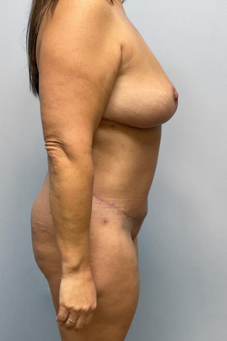 After image 2 Case #109286 - Mommy Makeover
